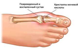 К какому врачу обращаться для лечения подагры?
