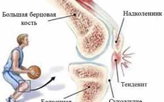 Тендинит собственной связки надколенника