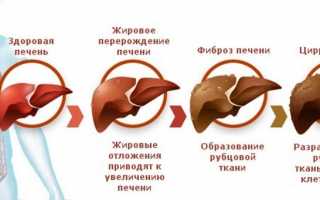 Симптомы цирроза печени у мужчин-алкоголиков