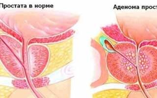 Можно ли пить Профлосин с алкоголем
