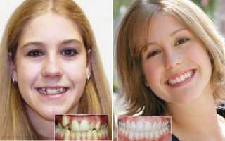 Ортодонтические элайнеры 3D Smile
