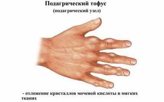 Почему болит сустав большого пальца на руке – лечение выявленной болезни